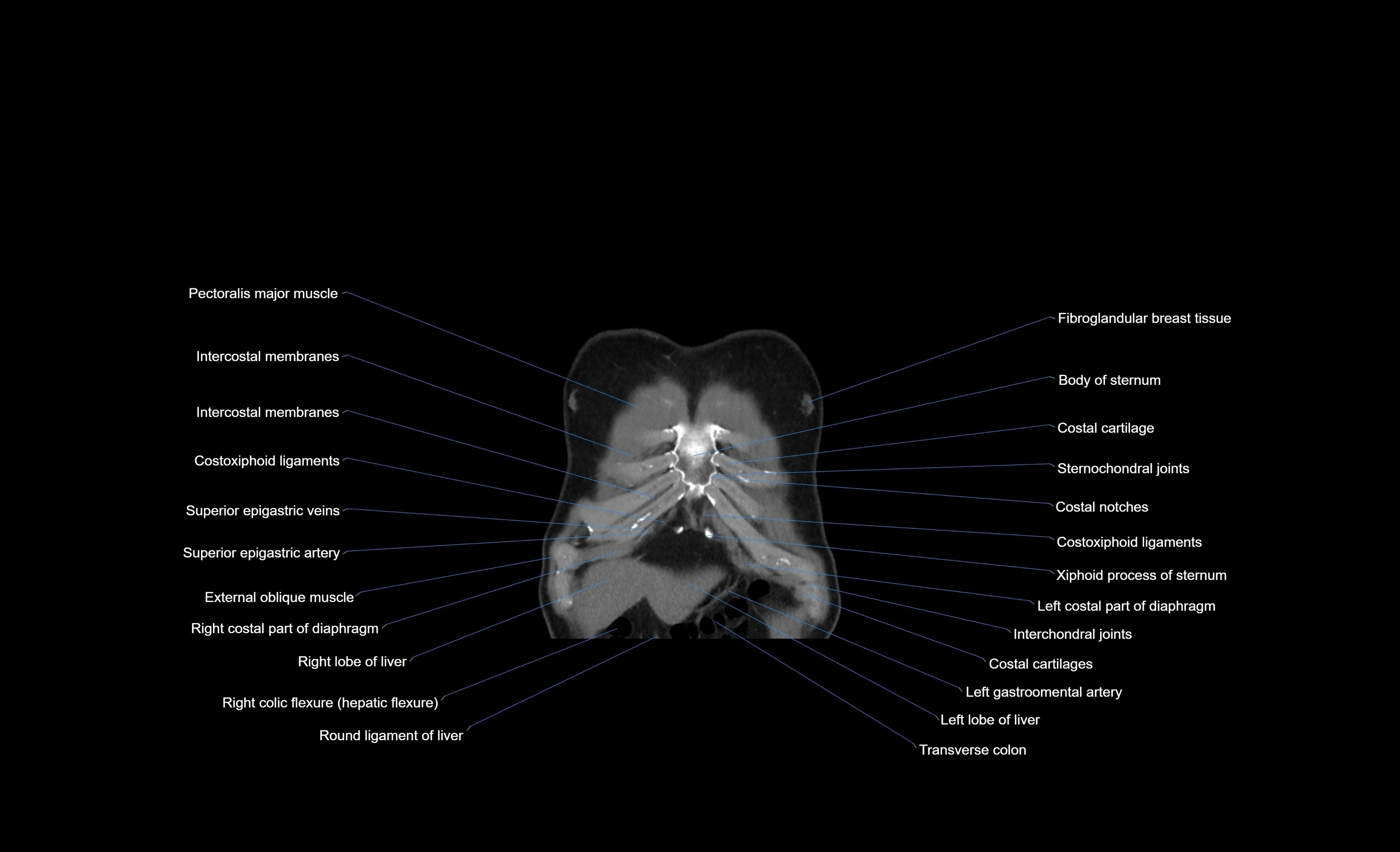 CT chest (thorax) labelled coronal cross sectional anatomy radiology image-00103.webp